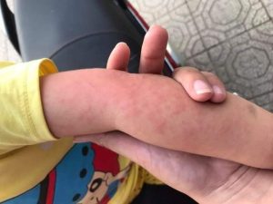 Trẻ bị rôm sẩy do nóng trong người, thời tiết nóng