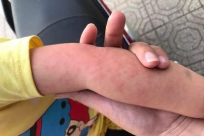 Cao atiso có công dụng gì đối với trẻ nhỏ?